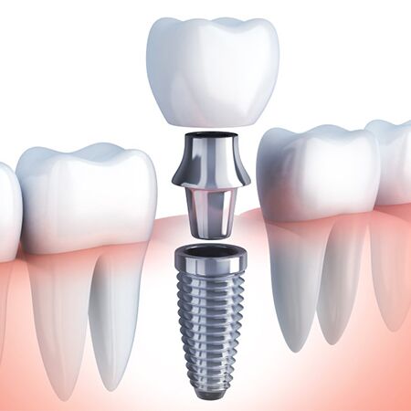 Implant dentar 1 Implant dentar
